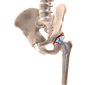 Hip Procedures - Florida Ortho Care